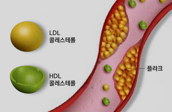 고지혈증 수치