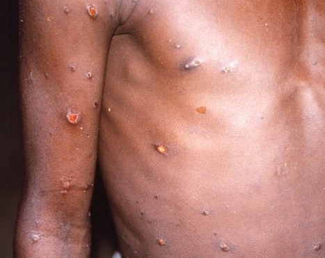 원숭이 두창 증상