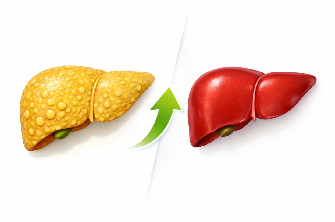 지방간이 관리 후 정상 간으로 회복되는 과정을 화살표로 표현한 비교 이미지