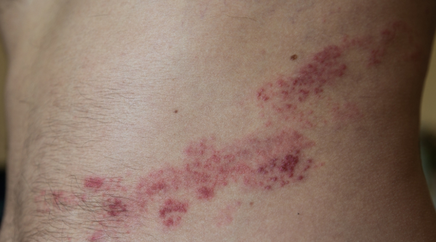 대상포진 증상, 원인, 치료방법