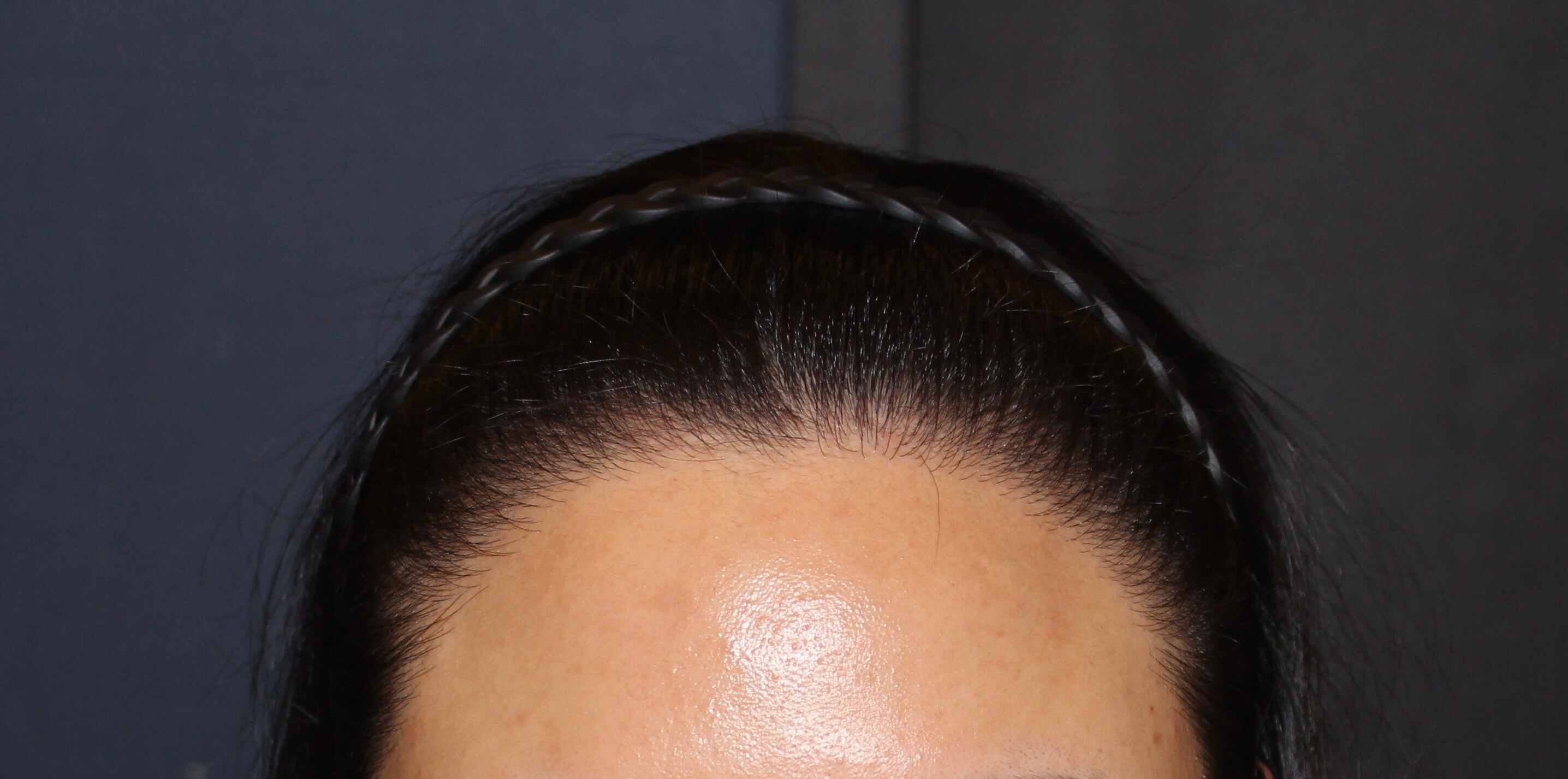 2차 보강 수술 전 정면