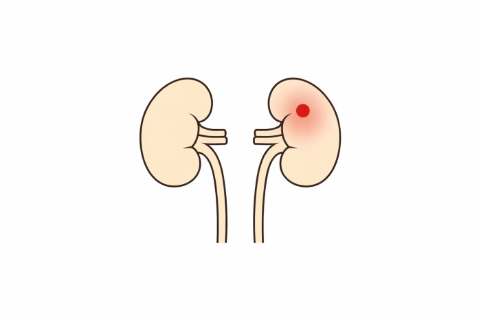 암환자 산정특례 제도