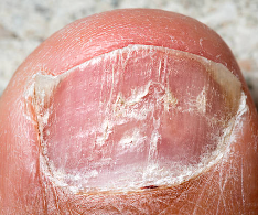 발톱 무좀 증상