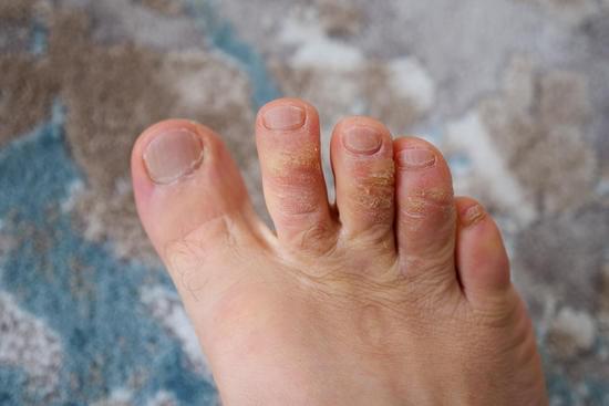 무좀(Tinea Pedis) &ndash; 발가락 사이 가려움의 정체