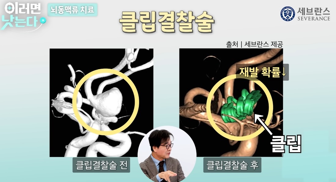 클립결찰술-뇌동맥류-김용배-교수-신경외과