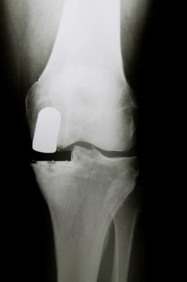 부분 인공관절 치환술 (Unicompartmental Knee Replacement)