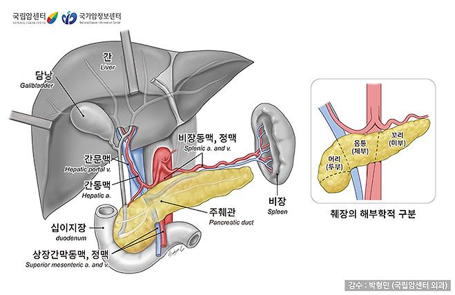 췌장암 초기증상