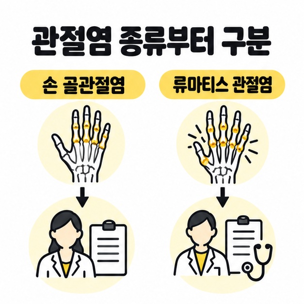 손 골관절염과 류마티스 관절염을 구분하고 진단에 따라 치료 방향이 달라짐을 보여주는 비교 도식