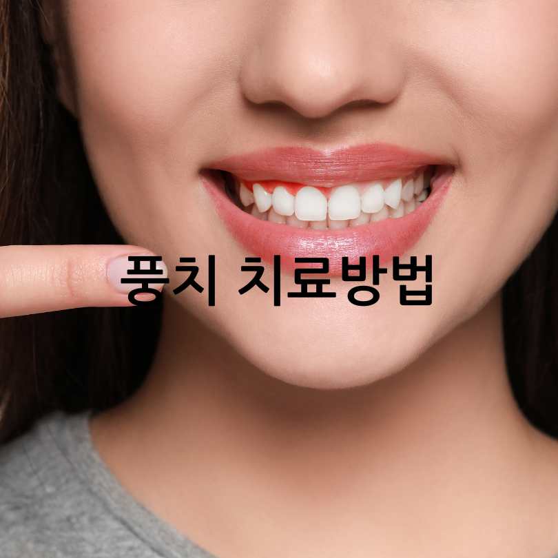풍치 원인, 증상, 치료법부터 발치