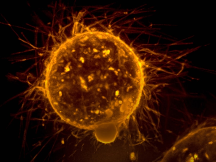 췌장암 초기증상 관리법 총정리