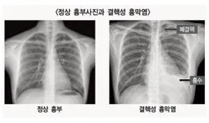 늑막에 물이 차는 이유와 치료 방법_1