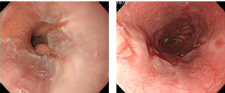 역류성 식도염 증상