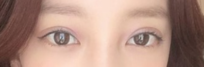 안검하수 수술비용과 수술방법 및 효과