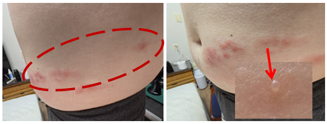 대상포진 수포가 생긴 증상