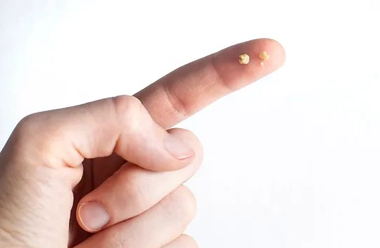 편도결석 빼는법 자연치유 방법 정리