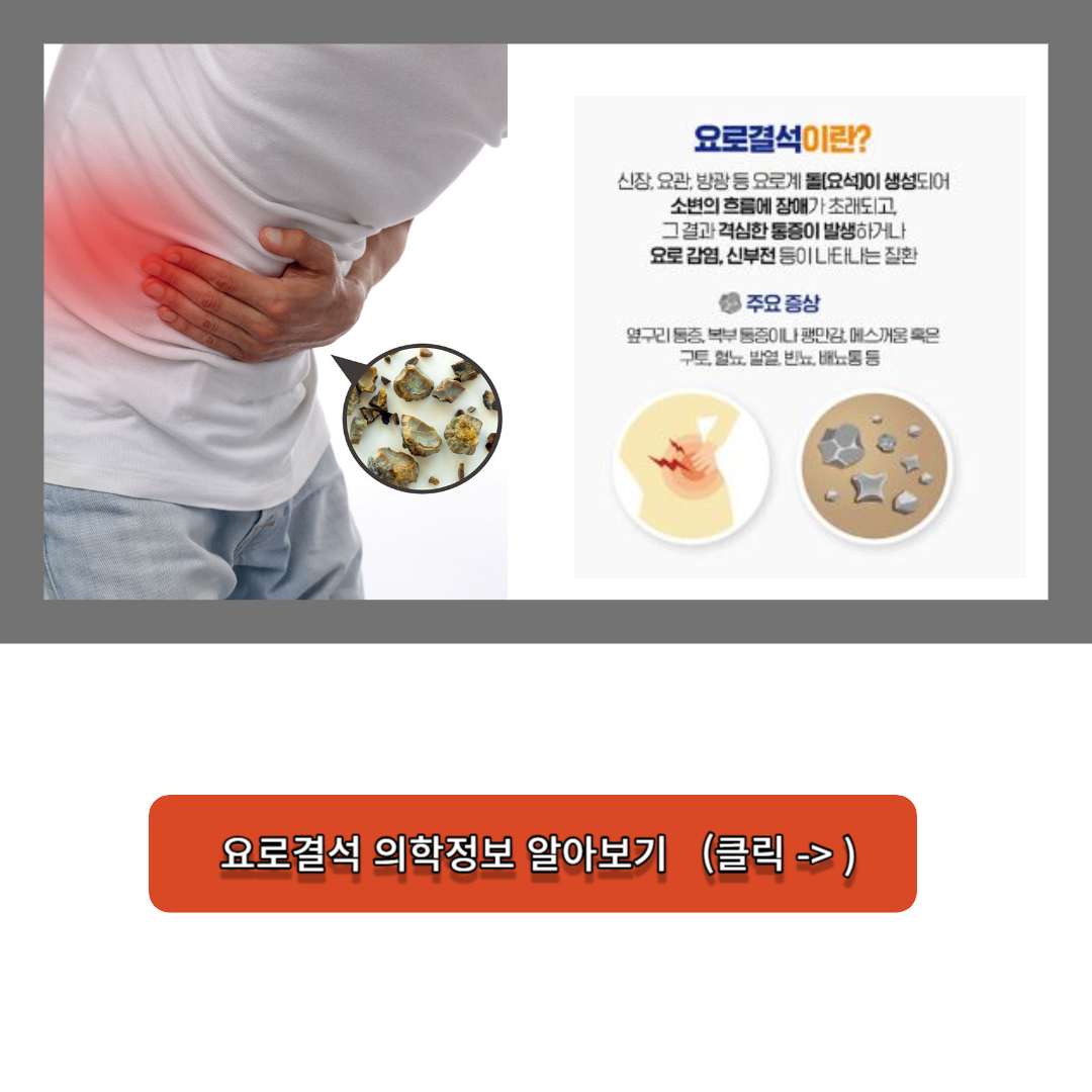 요로결석-의학정보