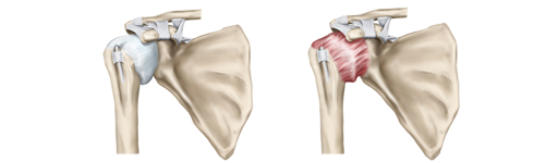 관절경수술 후 물리치료 운동 가이드