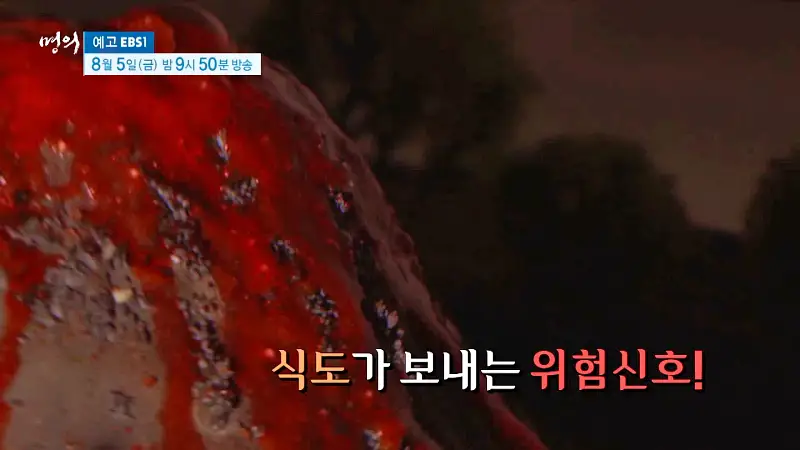 명의 타는 듯한 가슴 통증 식도가 보내는 SOS 역류성 식도염, 식도암 예방 방법 병원 추천 소개
