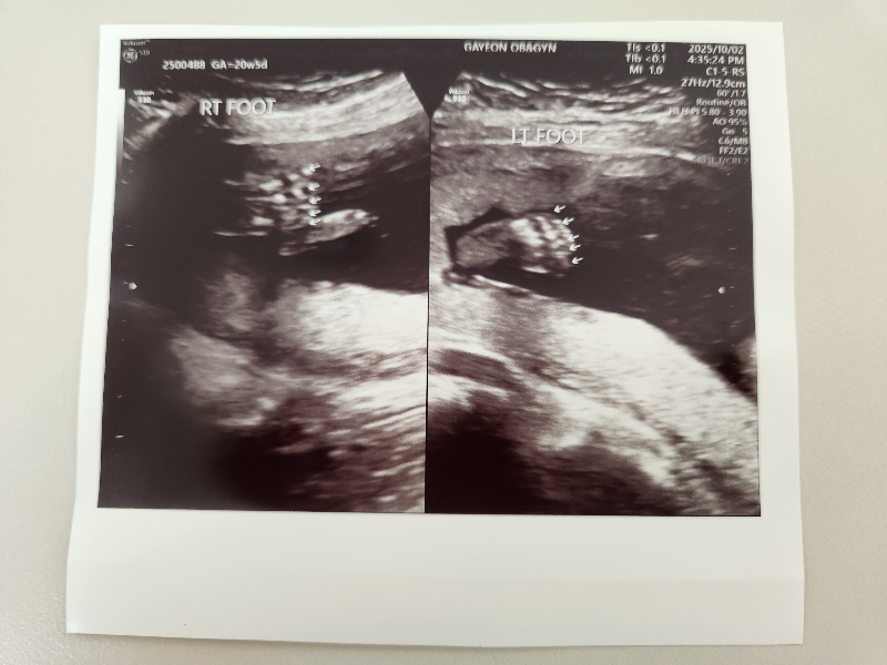 2차 정밀 초음파