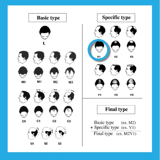 프로페시아 3개월 후기