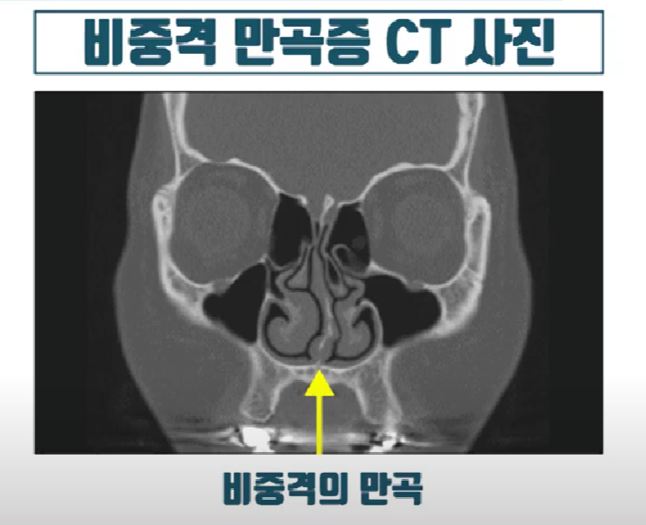 비중격만곡-CT사진