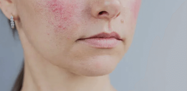 안면홍조 vs 주사피부염&amp;#44; 닮았지만 완전히 다른 빨간 얼굴 고민~!