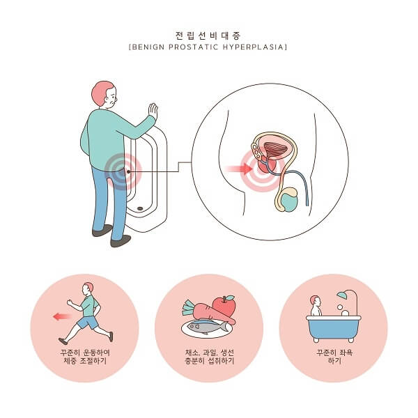 전립선비대증예방
