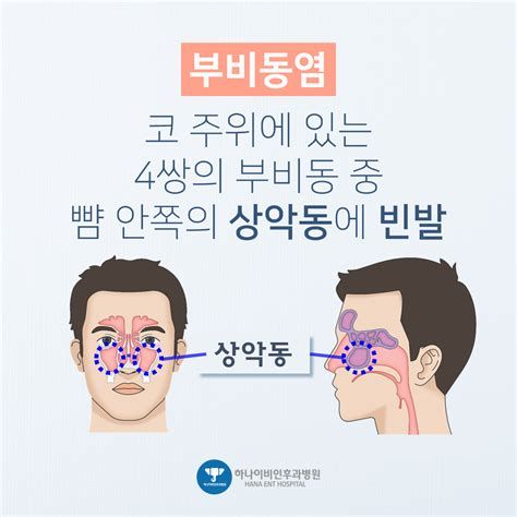 축농증