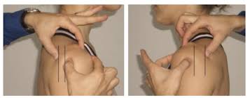 상완골 전방활주 관련 사진