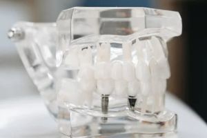 용인시-기흥구-임플란트-치과-가격-비용-싼-곳&amp;#44;저렴한-곳&amp;#44;잘하는-곳&amp;#44;유명한-곳-BEST20-추천6