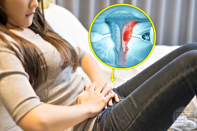 난소암 증상 전조증상 관계시 통증