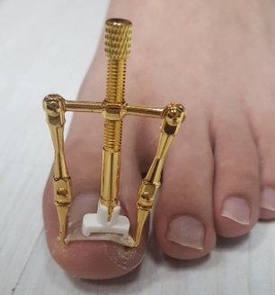 내성발톱 교정기