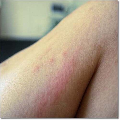 식물광피부염 증상