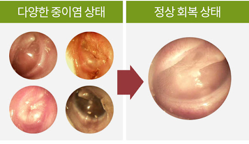 중이염 원인과 치료