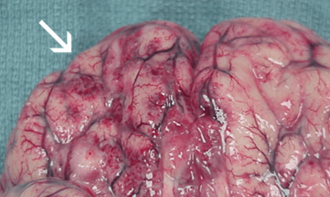 미국 뇌 먹는 아메바 네글레리아 파울러리 감염 후 뇌의 모습