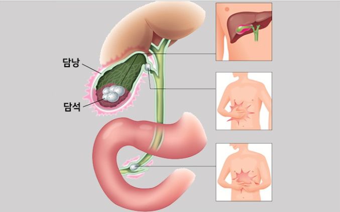 담낭절제술