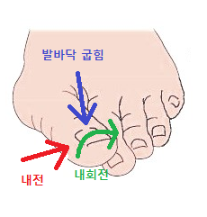 무지외반증