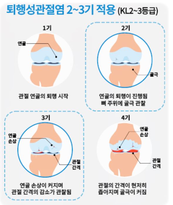 무릎줄기세포주사 가격 및 무릎줄기세포주사 실비 실손 보상 / 전국 병원추천