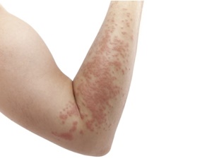 알루미늄 알레르기