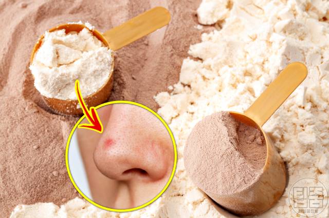 피부노화 원인 카제인단백질 여드름