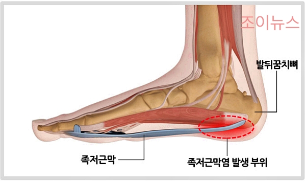 족저근막염이란?출처:국가건강정보포털