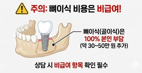임플란트 뼈이식 비용