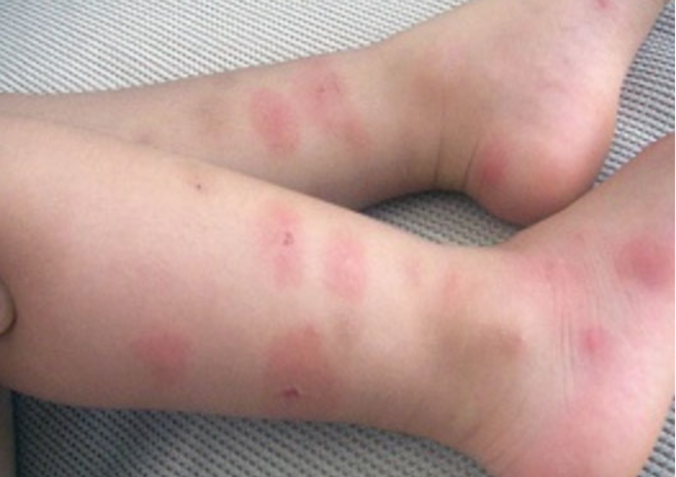 모기 알레르기 예방법