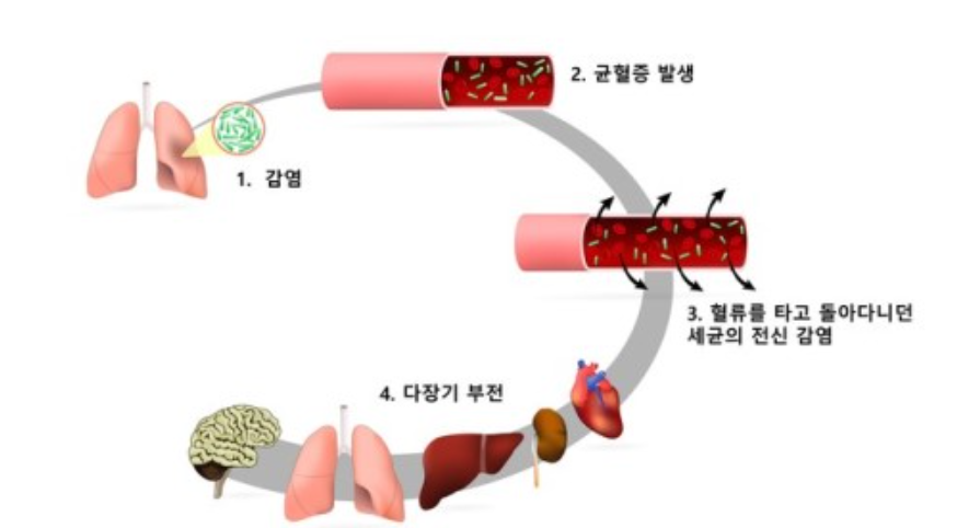패혈증-급성패혈증