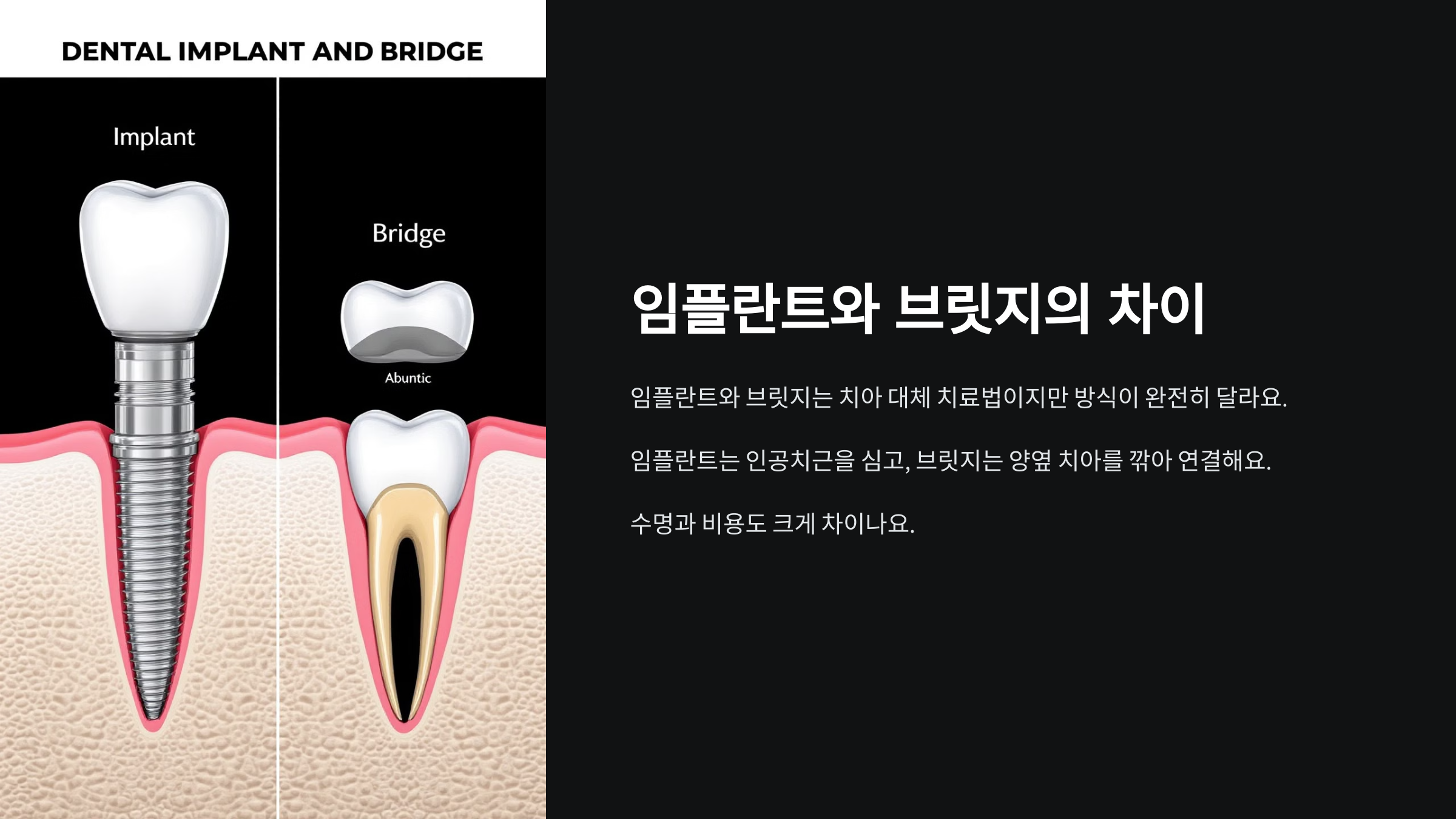 임플란트와 브릿지의 차이