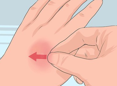 쐐기벌레 쏘였을때 증상 물리면 통증 독 병원 약 종류 응급처치 총정리1