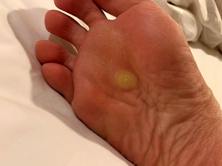 발바닥에 사마귀가 크게 자라서 앤드와츠를 바른 사진