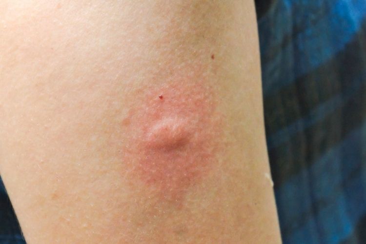 모기에 물린 남성