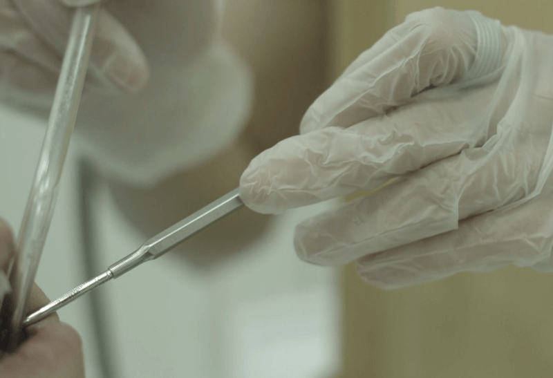 치과-치석제거-스케일링