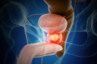 전립선암 생존율